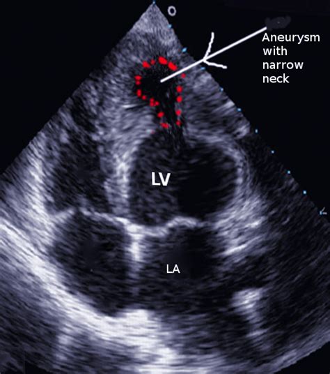 lv aneurysm on echo.